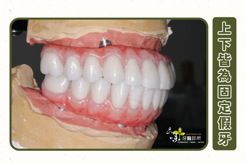 上下皆為固定假牙者，治療前就要在患者無牙狀態時去取得取得上下顎間關係，再進行牙齒排列設計，最後使用「全口固定式臨時假牙」讓患者實際使用 4 ~ 6 個月。
