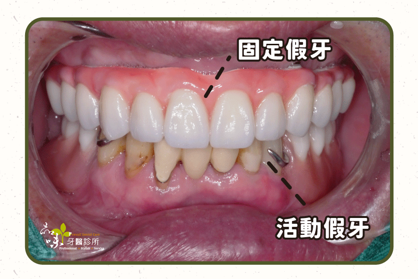 一側為固定假牙,一側為固定假牙,活動假牙的咬合力較小,可能耗損較快