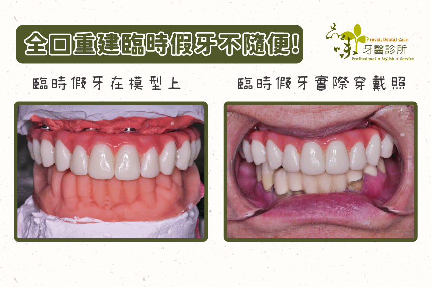 全口重建臨時假牙不隨便,先在模型上進行模擬,再實際穿戴,縮短患者等待時間。