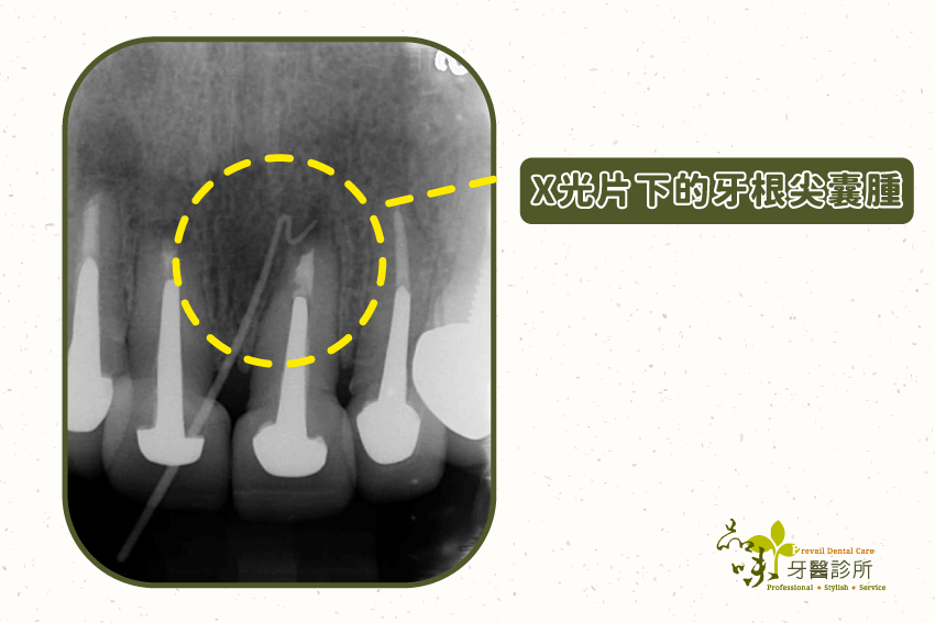 X光片下的牙根尖囊腫