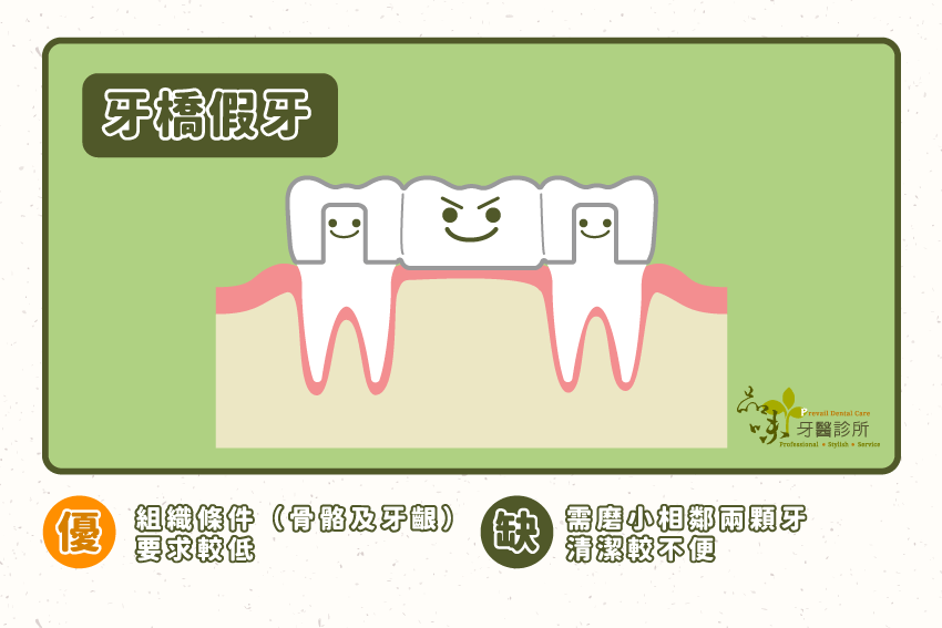 牙橋假牙
對於缺牙區的組織條件(骨骼及牙齦)要求較低。 缺點是需磨小相鄰兩顆牙;需使用牙間刷清潔牙橋底部,清潔較不便。