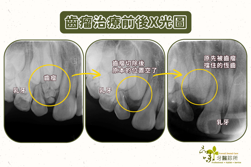 齒瘤治療前後Ｘ光圖。
將齒瘤切除後，原先被擋住的恆齒才可以繼續生長，順利換牙。