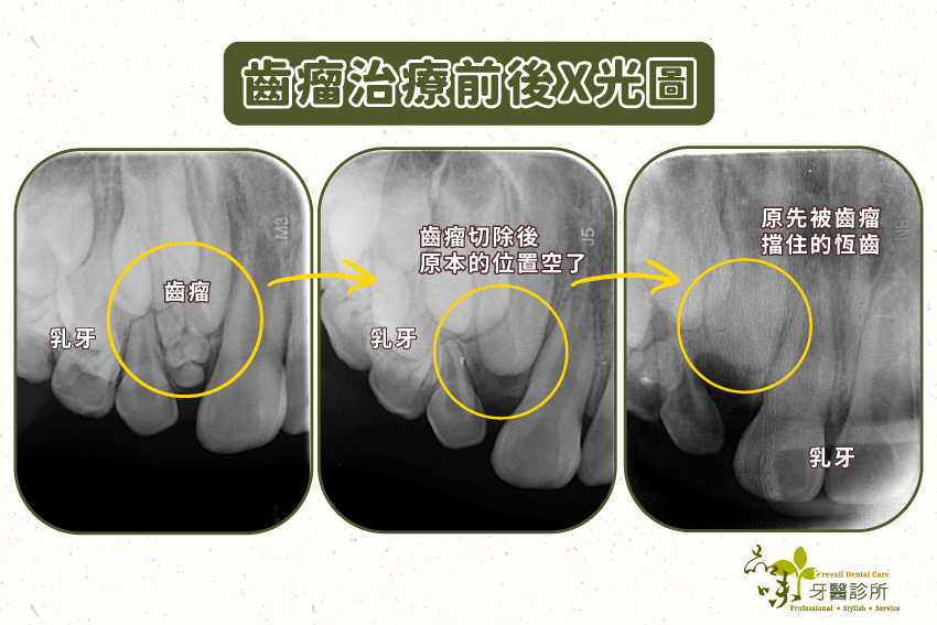 齒瘤治療前後X光圖。
將齒瘤切除後,原先被擋住的恆齒才可以繼續生長,順利換牙。