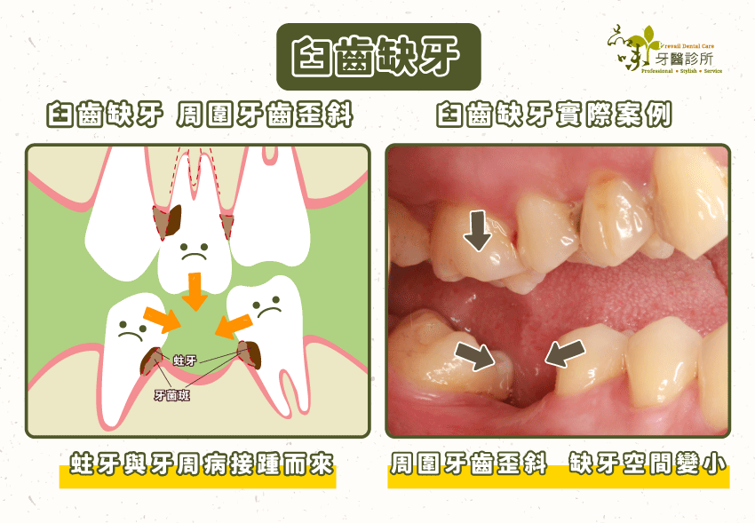 變形的牙齒排列會增加蛀牙及牙周病的發生率；變小的缺牙空間將會造成後續做假牙困難，嚴重者需要先做牙齒矯正。