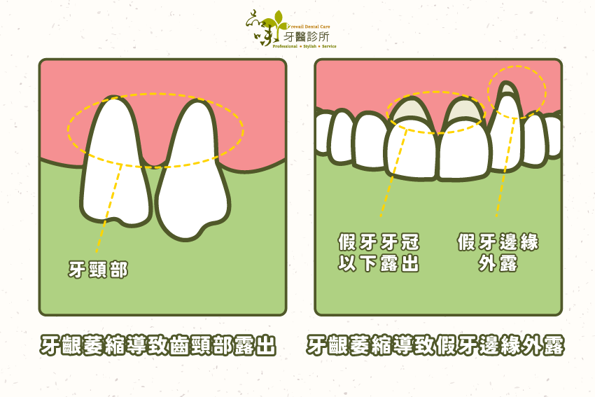 牙齦萎縮會導致齒頸部外露、假牙邊緣外露