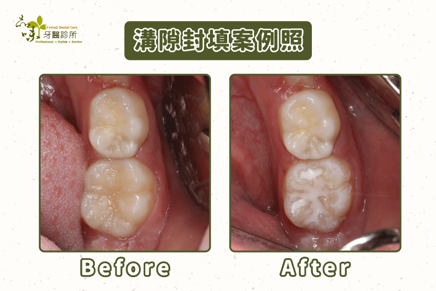 溝隙封填實際案例照
溝隙封填可降低第一大臼齒蛀牙機率