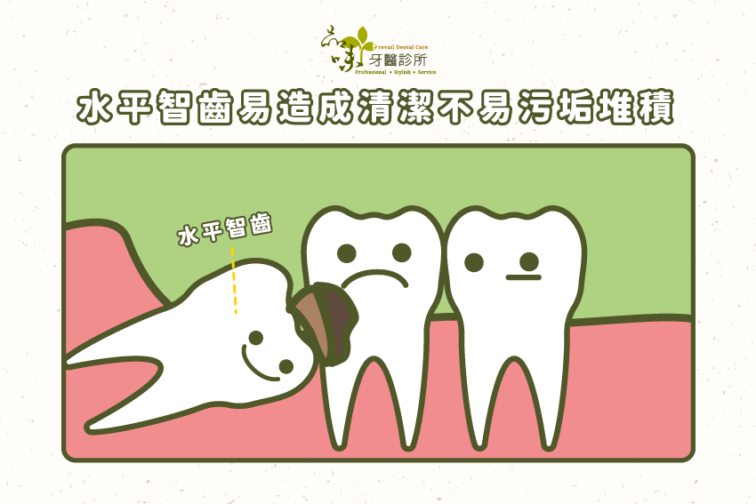 水平智齒會有的潛在問題。
因為位置的關係，清潔不易，可能造成蛀牙，連帶的前一顆牙齒可能也因此受害，輕則根管治療，重則可能也需要被一起拔除。