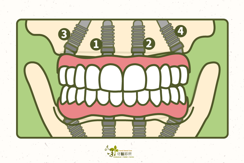 All-on-4最少需要四支植體，分別種植在門牙與犬齒附近，以及第二小臼齒及第一大臼齒周邊，透過它們接出自左至右相連的假牙，如此便能提供成年人適當的咬合功能>